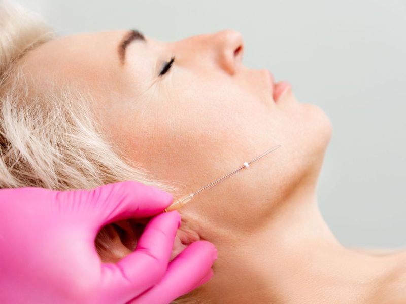 Thread lifts, or “soft lifts,” correct skin laxity in a way similar to a cervicofacial lift… but without surgery.