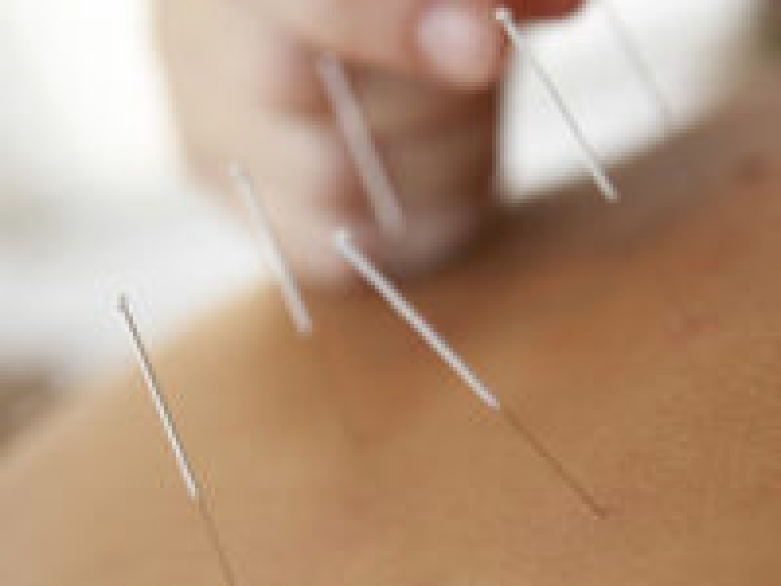 Traditional acupuncture