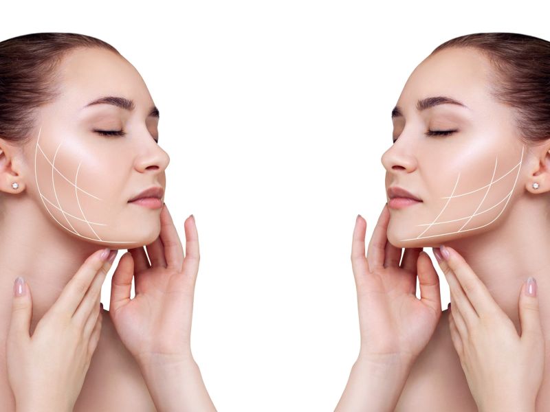 Tensor threads correct sagging of the oval of the face in the same way as a facelift