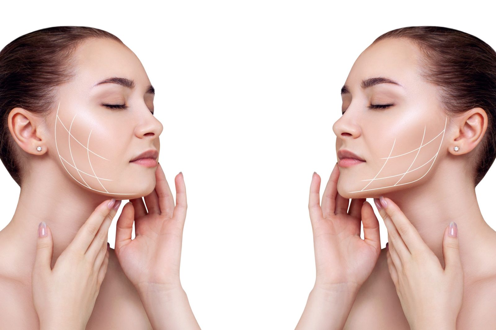 Tensor threads correct sagging of the oval of the face in the same way as a facelift