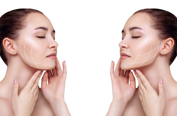 Tensor threads correct sagging of the oval of the face in the same way as a facelift