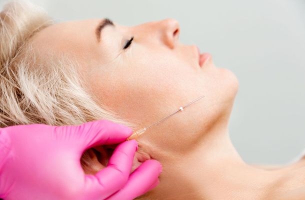 Thread lifts, or “soft lifts,” correct skin laxity in a way similar to a cervicofacial lift… but without surgery.