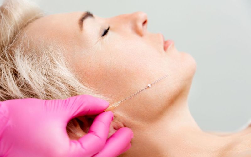 Thread lifts, or “soft lifts,” correct skin laxity in a way similar to a cervicofacial lift… but without surgery.