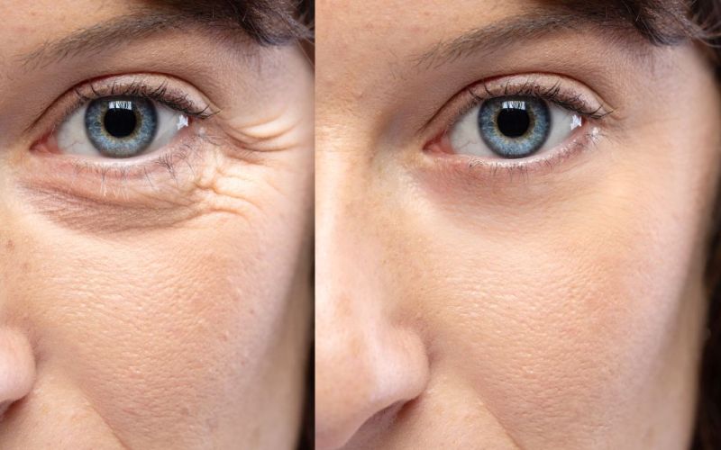Botox injections before and after