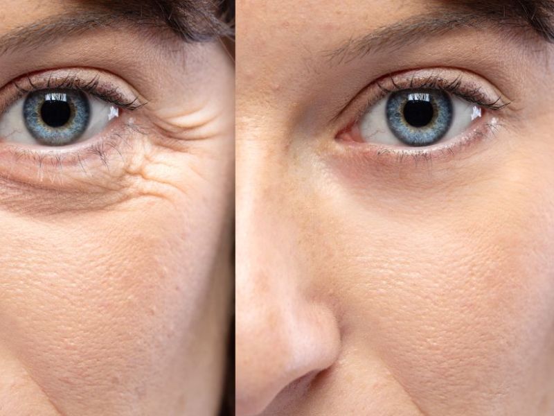 Botox injections before and after