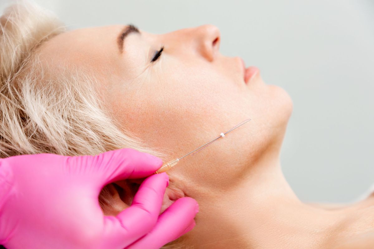 Thread lifts, or “soft lifts,” correct skin laxity in a way similar to a cervicofacial lift… but without surgery.