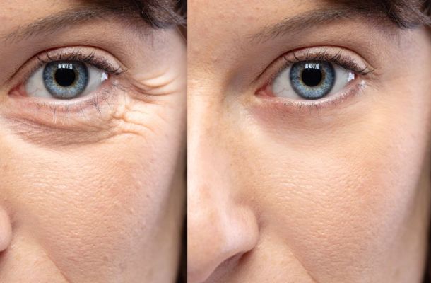 Botox injections before and after