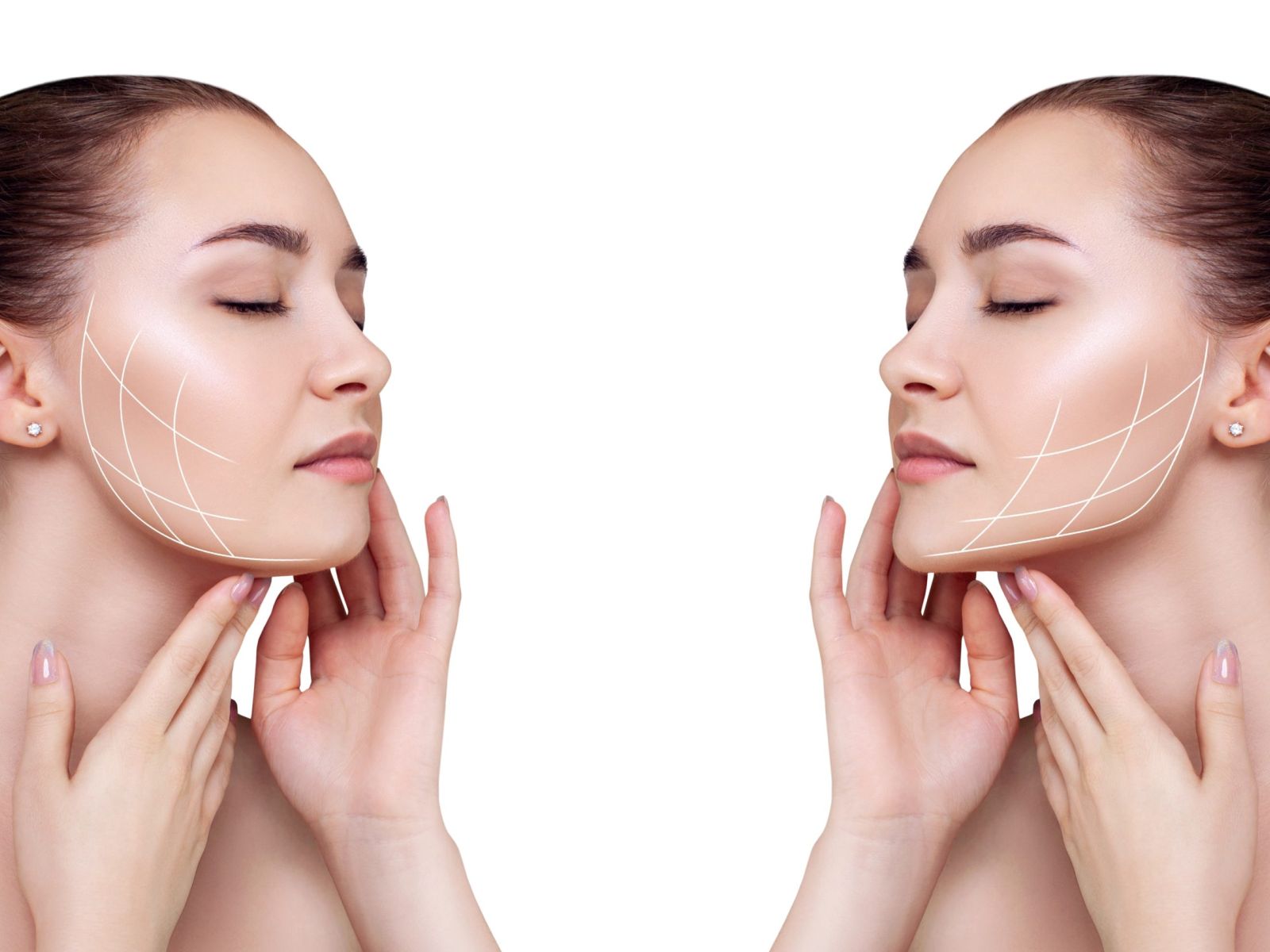 les fils tenseurs corrigent le relâchement de l'ovale du visage à la manière d'un lifting