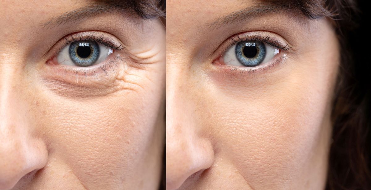 Botox injections before and after