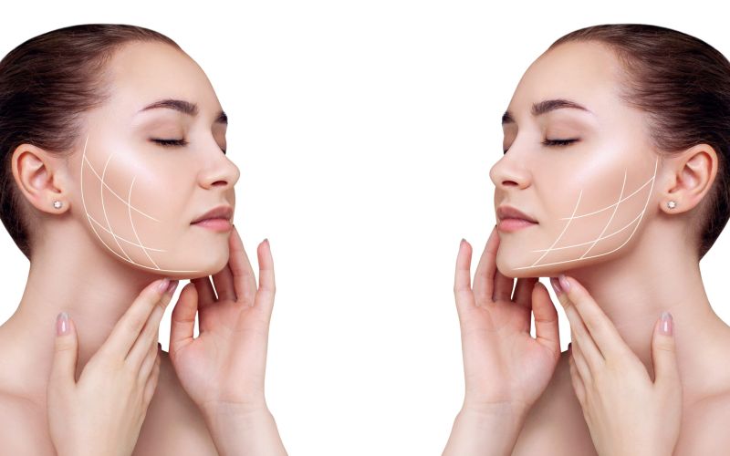 Tensor threads correct sagging of the oval of the face in the same way as a facelift
